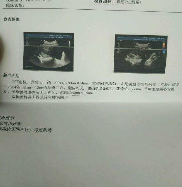 单角子宫女性试管助孕可行性与费用指南